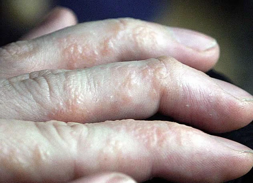 Bàn tay bị chàm tổ đỉa với nhiều mụn nước nhỏ, li ti.