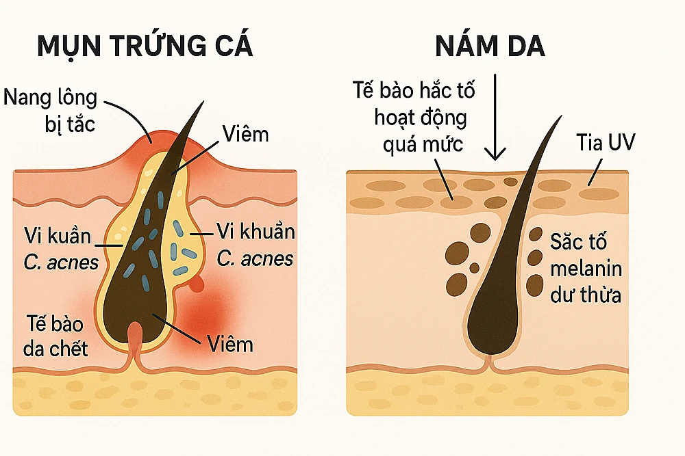 co-che-hinh-thanh-mun-nam.png Sơ đồ y khoa giải thích cơ chế hình thành mụn và nám trên da.