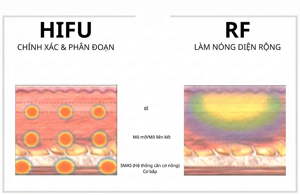 So sánh cơ chế tác động nhiệt dưới da của HIFU và RF.