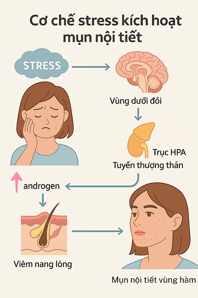 Cơ chế stress kích hoạt mụn nội tiết