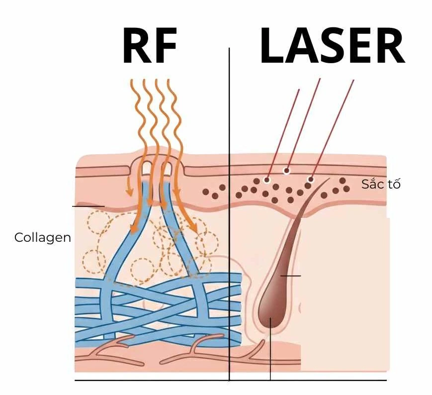  Sơ đồ so sánh cơ chế tác động của sóng RF và laser trên da, làm rõ vì sao RF facial an toàn cho mọi tông da.