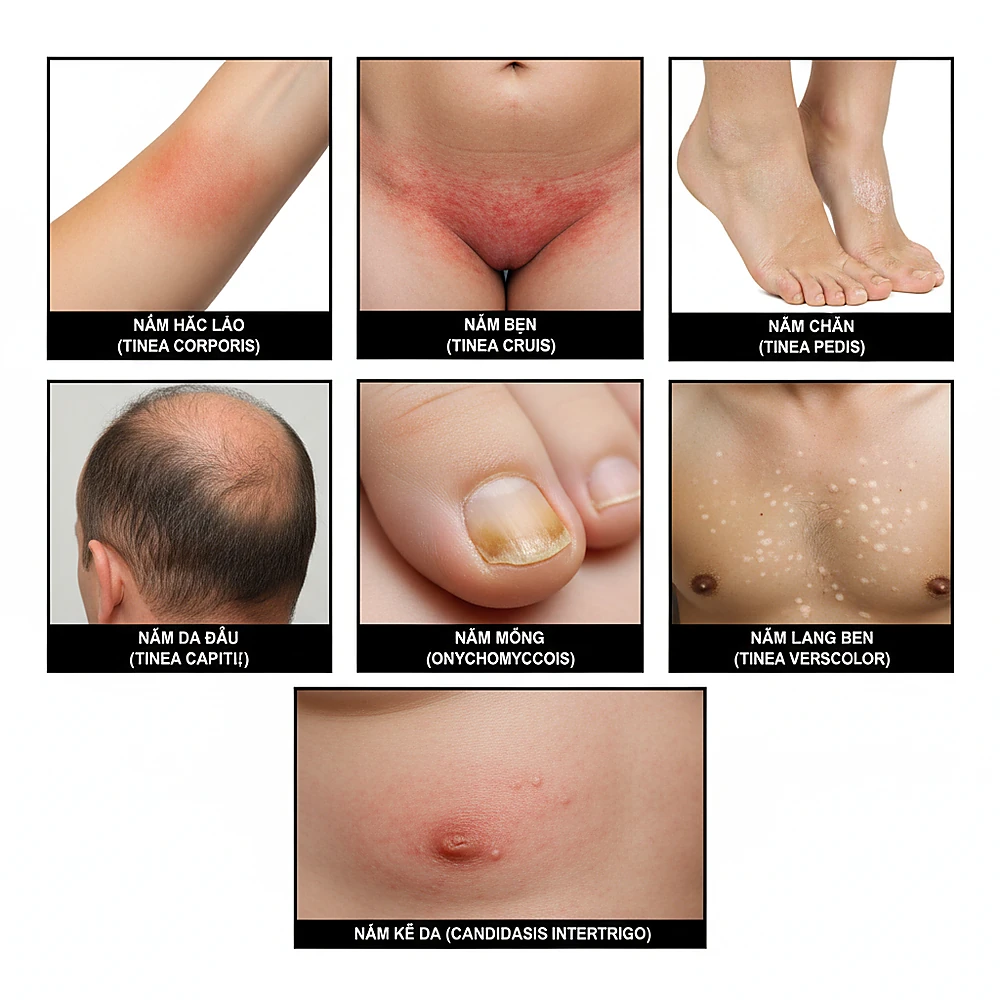Tổng hợp hình ảnh các thể nhiễm nấm da: thân, bẹn, chân, da đầu, móng, lang ben và Candida.