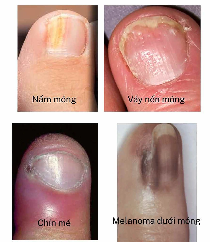 Các dấu hiệu lâm sàng thường gặp trong bệnh móng: đổi màu, dày, rỗ, viêm, vệt nâu bất thường