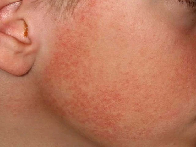Dày sừng nang lông teo da ở mặt