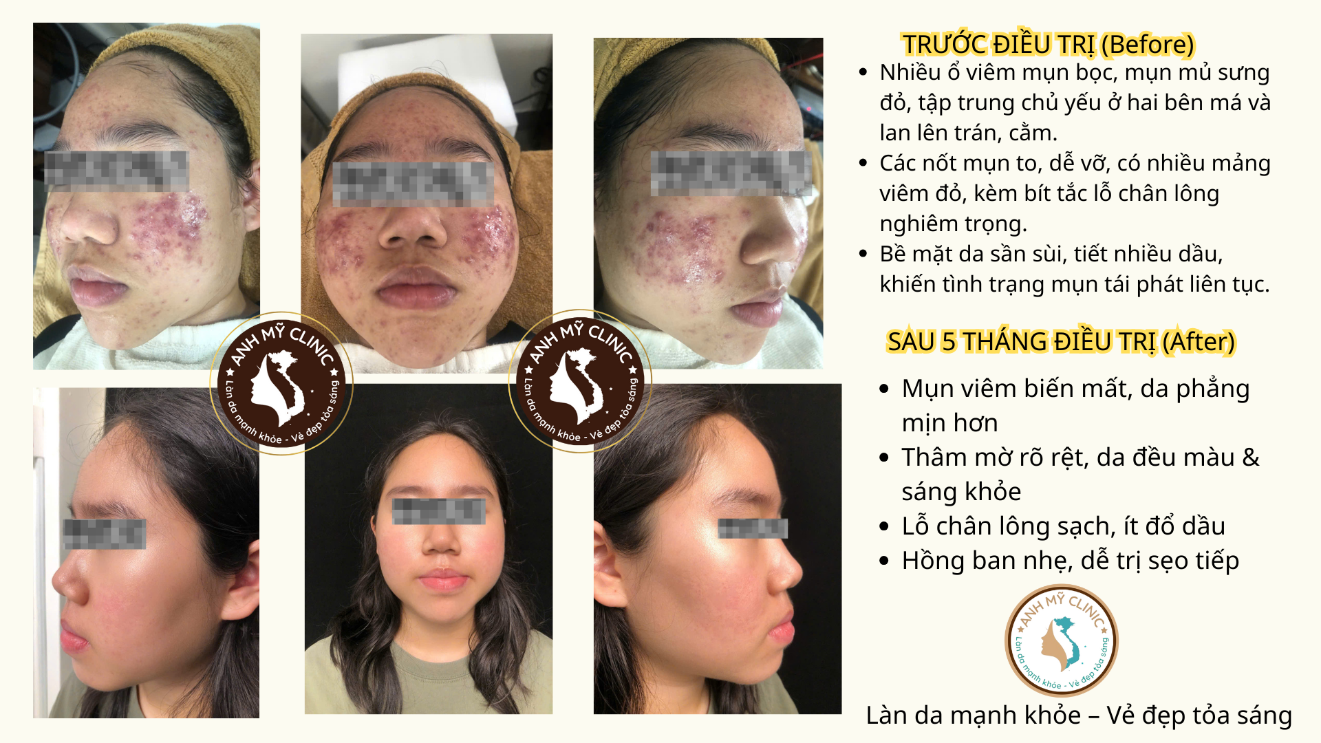 Hiệu quả điều trị mụn trứng cá nặng sau 5 tháng tại phòng khám da liễu TPHCM Anh Mỹ Clinic