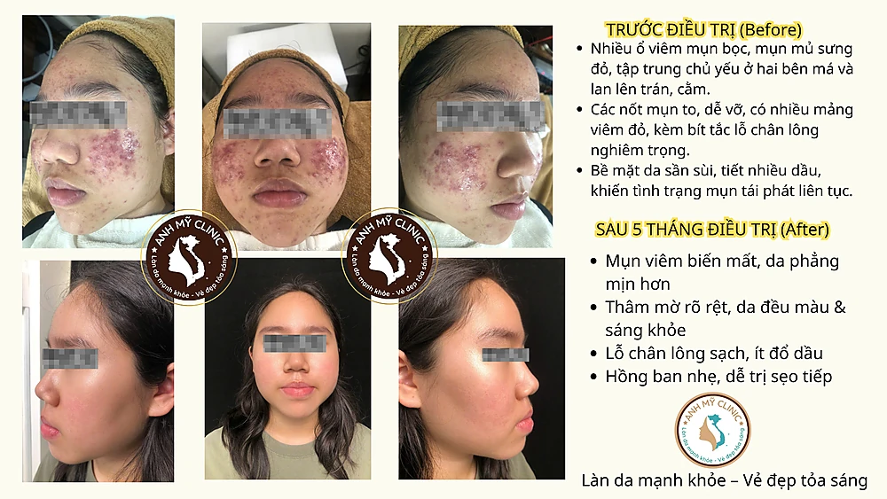 Hiệu quả điều trị mụn trứng cá nặng sau 5 tháng