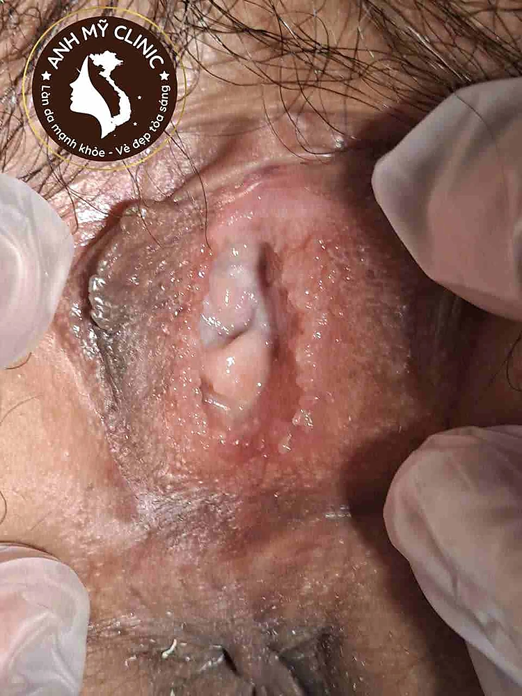 Nhiều nhú nhỏ đồng dạng ở vùng tiền đình âm hộ, phù hợp gai sinh dục vùng tiền đình lành tính