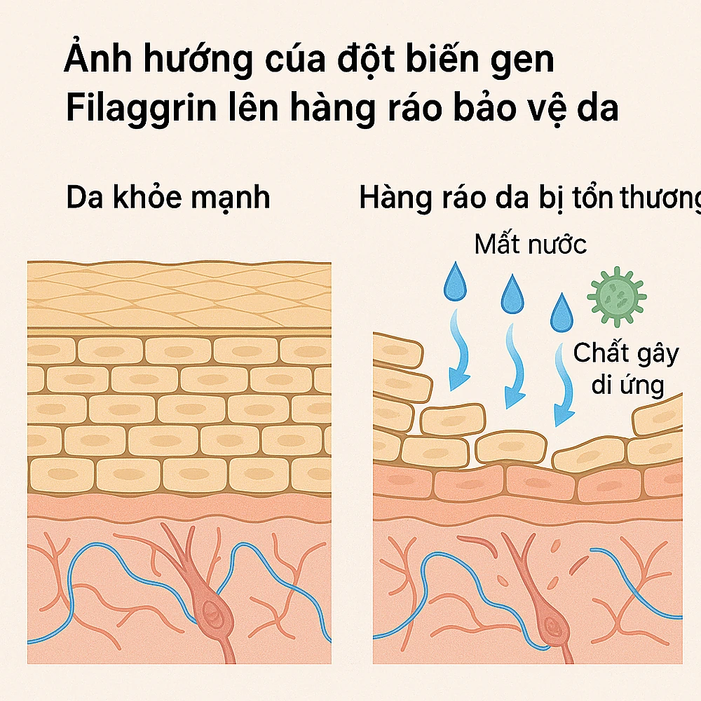So sánh da bình thường và da mang đột biến filaggrin.