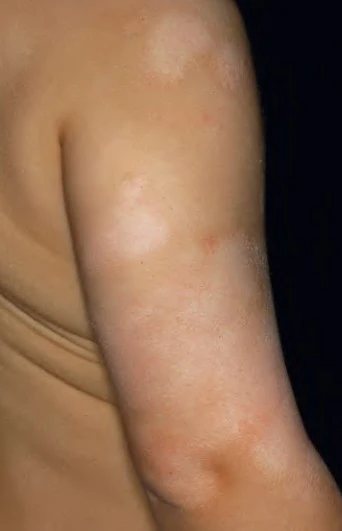 Giảm Sắc Tố Sau Viêm Ở Viêm Da Cơ Địa