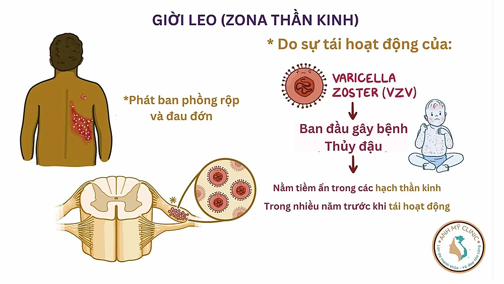 Phân biệt với Zona thần kinh