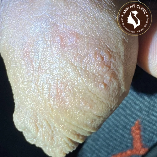 Mụn nước bao quy đầu do Herpes Simplex