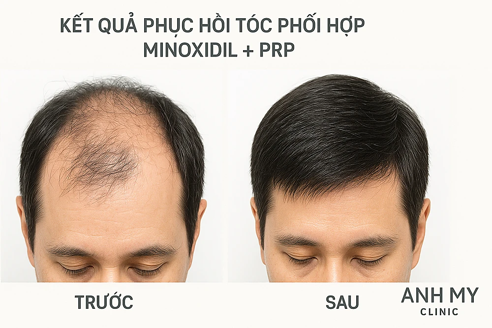  Ảnh trước và sau điều trị kết hợp Minoxidil và PRP cho bệnh nhân rụng tóc tại Phòng Khám Da Liễu Anh Mỹ