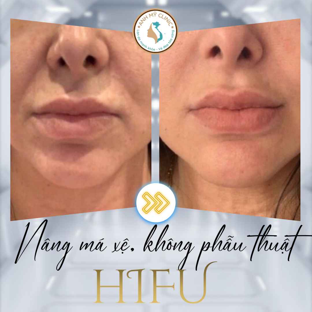 HIFU nâng cơ má xệ không phẫu thuật — hình trước sau