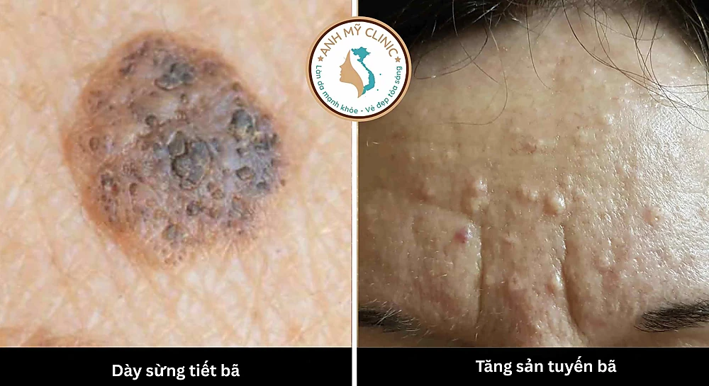 Soi da là công cụ không thể thiếu giúp bác sĩ phân biệt các tổn thương lành tính như dày sừng tiết bã và tăng sản tuyến bã với các dạng ung thư da. 