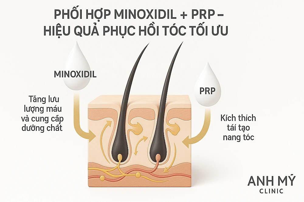 Sơ đồ mô tả cơ chế bổ trợ giữa Minoxidil và PRP giúp tăng mật độ tóc nhanh chóng tại Anh Mỹ Clinic