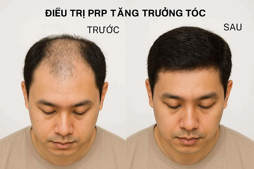 Hình ảnh trước và sau điều trị rụng tóc bằng PRP tại Anh Mỹ Clinic.