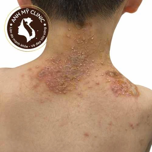 Tổn thương do kiến ba khoan 1