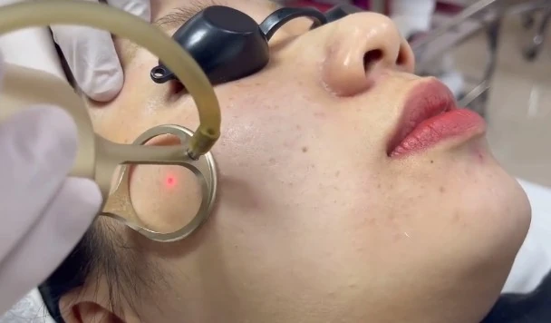 Laser Fractional CO 2