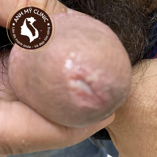 lau.png Mủ lỗ tiểu do lậu