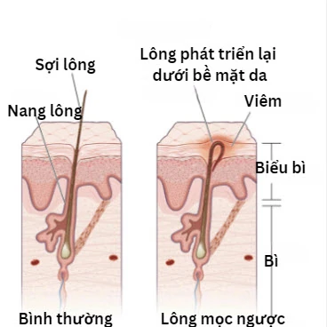 long-binh-thuong-va-long-moc-nguoc.jpg Lông bình thường và lông mọc ngược