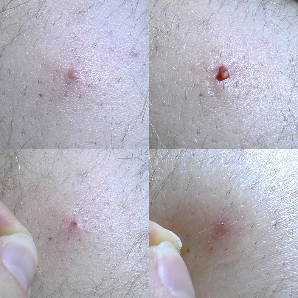 long-moc-nguoc-nhiem-trung-cap-tinh.jpg Lông mọc ngược nhiễm trùng cấp tính