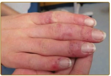 Lupus Đỏ Cước