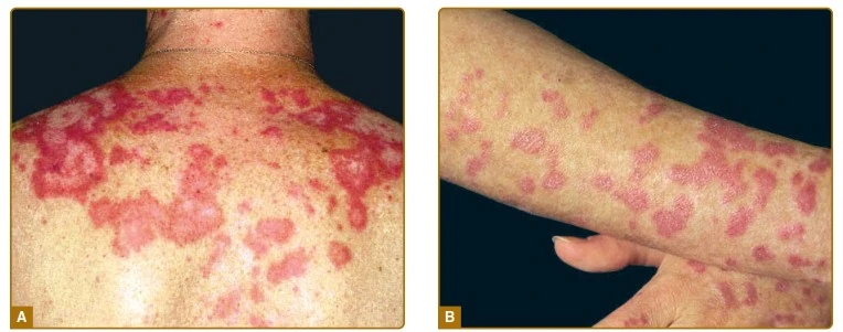 Lupus Đỏ Da Bán Cấp