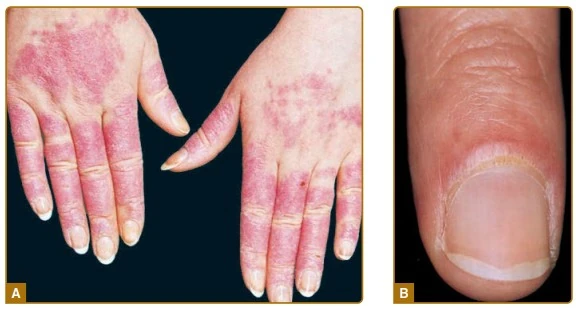 Lupus Đỏ Da Cấp