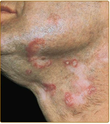 Lupus Đỏ Dạng Đĩa