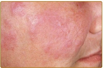 Lupus Đỏ Phù Nề