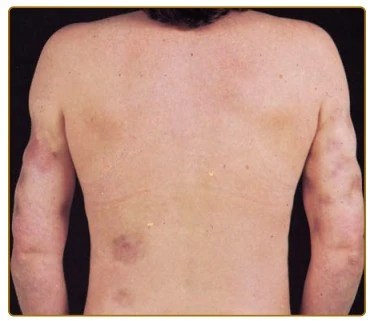 Lupus Đỏ Viêm Mô Mỡ