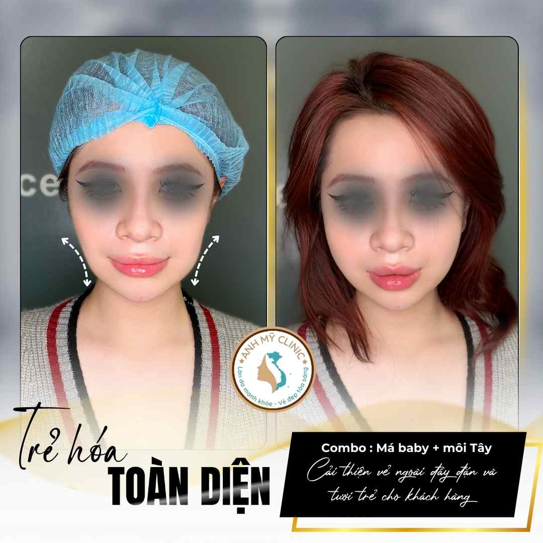 Filler má và môi — hình trước sau tại Anh Mỹ Clinic