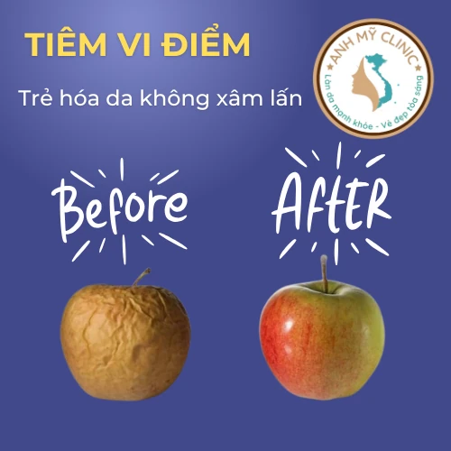 Tiêm vi điểm