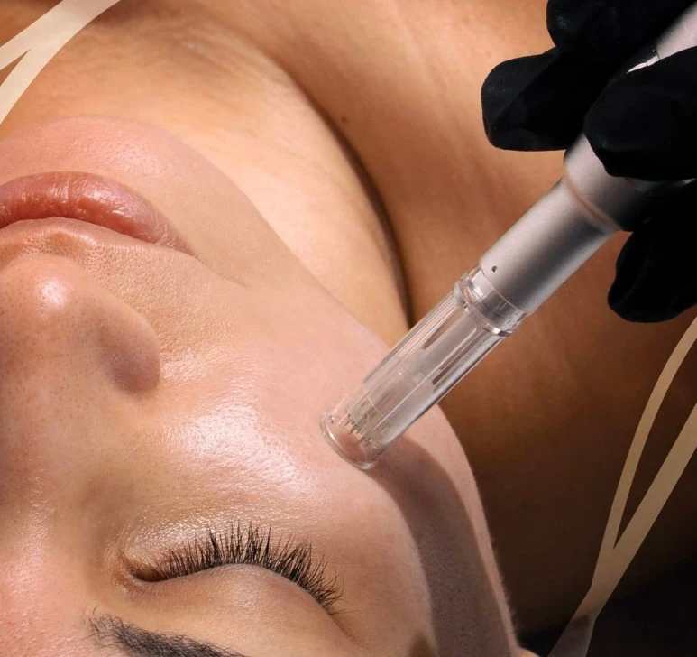 Microneedling