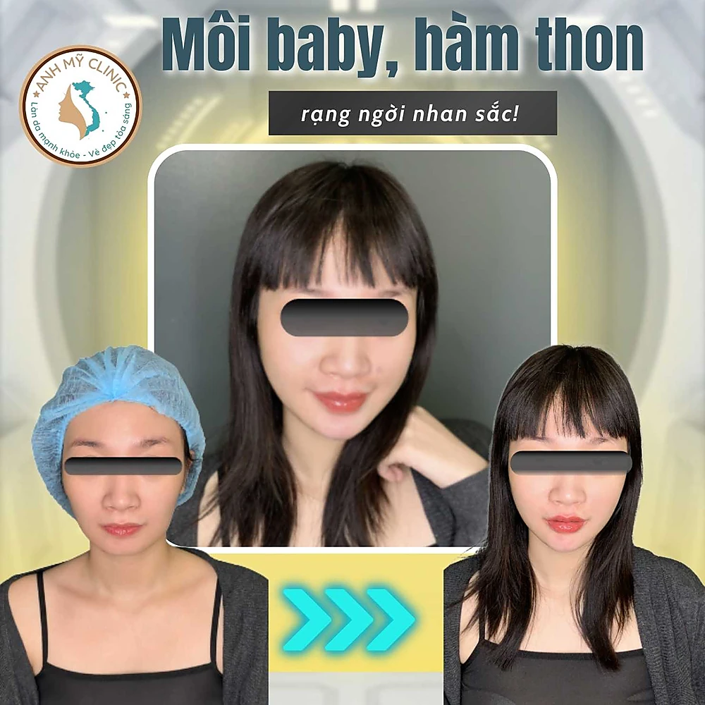 Combo môi & hàm