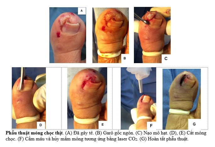  phẫu thuật điều trị móng chọc thịt bằng kỹ thuật partial avulsion – Phòng Khám Da Liễu Anh Mỹ.