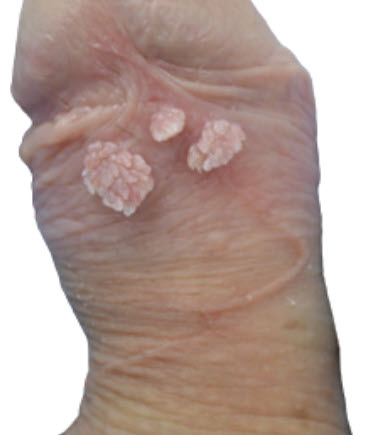 Mồng gà dương vật