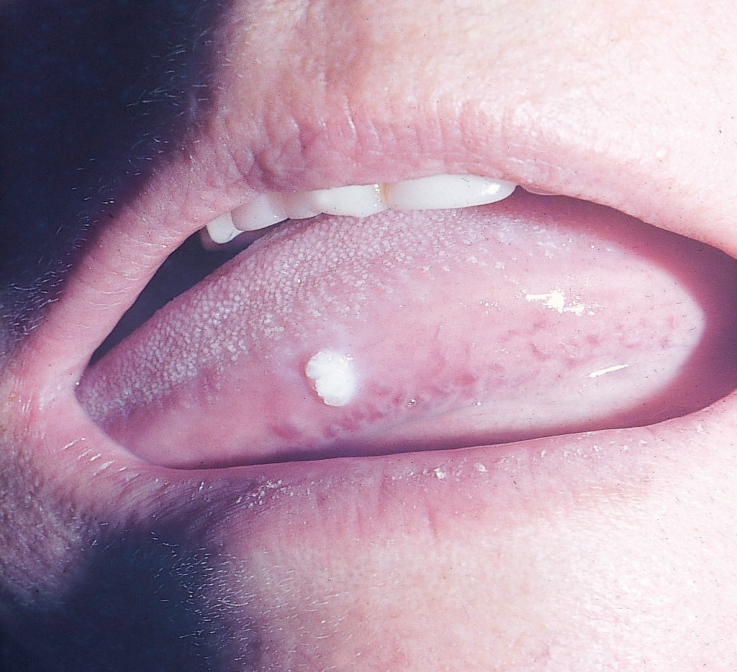 Mồng gà lưỡi