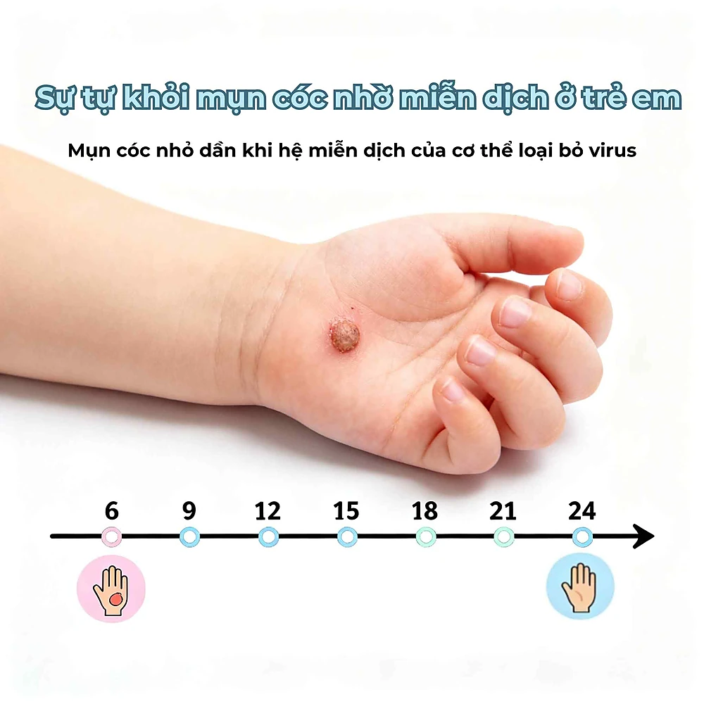 Minh họa tiến trình mụn cóc ở trẻ em tự biến mất nhờ hệ miễn dịch trong vòng 6–24 tháng