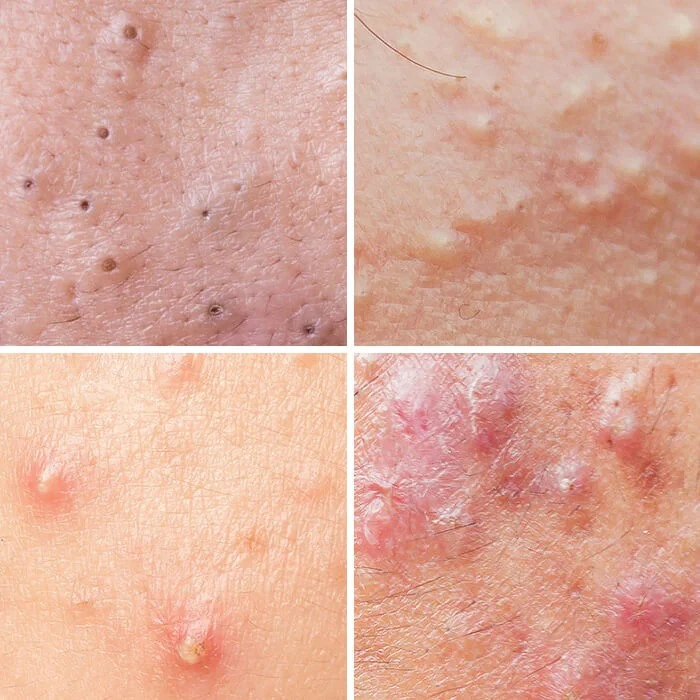 Các Loại Mụn Trứng Cá