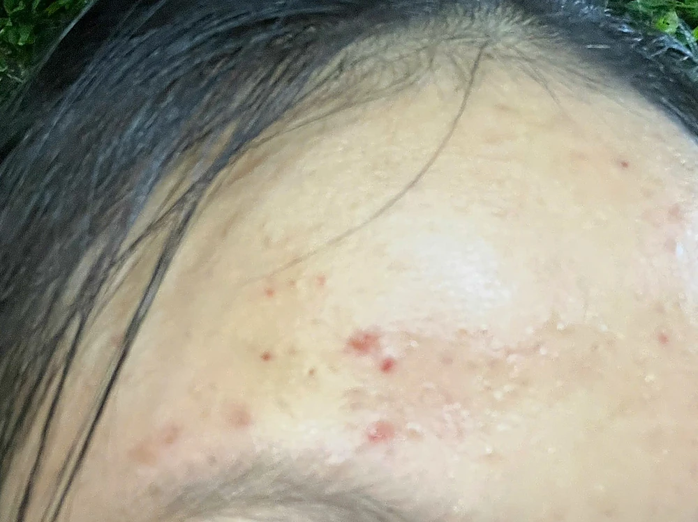 Mụn Trứng Cá Cào Xước