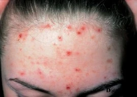 Mụn Trứng Cá Cào Xước