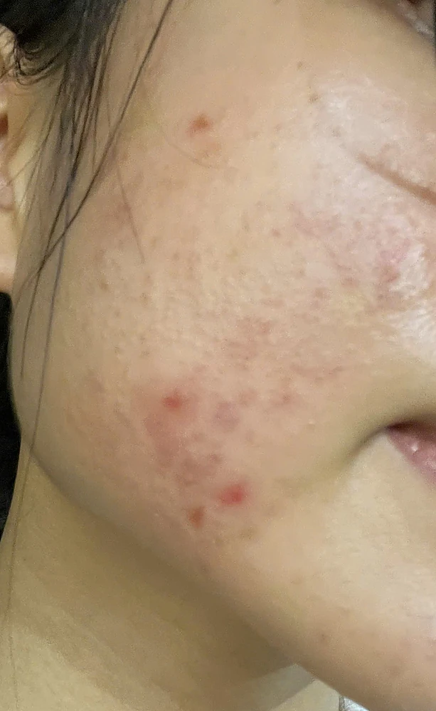 Mụn Trứng Cá Cào Xước
