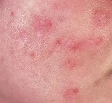 Mụn Trứng Cá Cào Xước