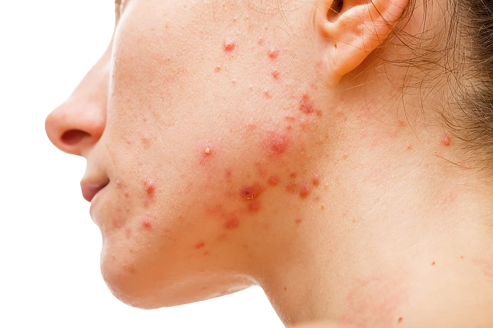 Mụn nội tiết tuổi dậy thì nữ tập trung vùng hàm–cằm, bùng phát theo chu kỳ kinh.