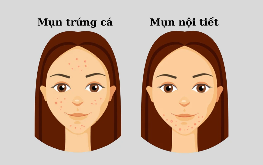 Mụn trứng cá so với mụn nội tiết