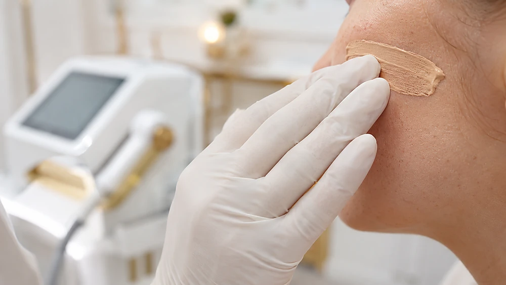 Thoa kem chống nắng có màu chứa oxit sắt hỗ trợ điều trị nám mạch máu