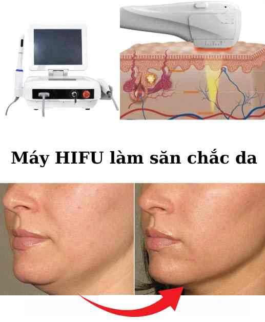 HIFU nâng cơ giảm nọng cằm
