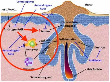 Hình minh họa y học mô phỏng sự hình thành mụn trứng cá ở tuổi dậy thì, với các yếu tố như hormone androgen, tuyến bã nhờn, và viêm được thể hiện rõ ràng. Hình ảnh chi tiết cấu trúc da, với các mũi tên chỉ rõ các yếu tố ảnh hưởng đến mụn.