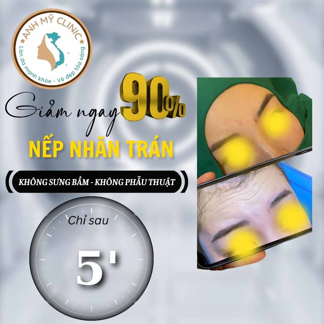 Tiêm botox xóa nếp nhăn trán — hình trước sau